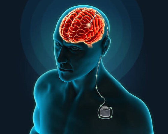 Hlboká mozgová stimulácia je jednou z invazívnych metód liečby